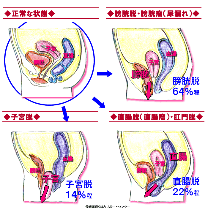 骨盤臓器脱の図（膀胱脱・直腸脱・子宮脱）